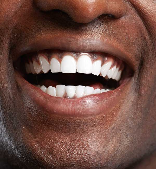 Teeth Whitening San Francisco teeth